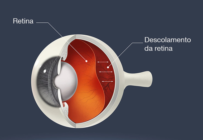 Saiba mais sobre Descolamento de retina com a Clínica Carlos Grossi Oftalmologia