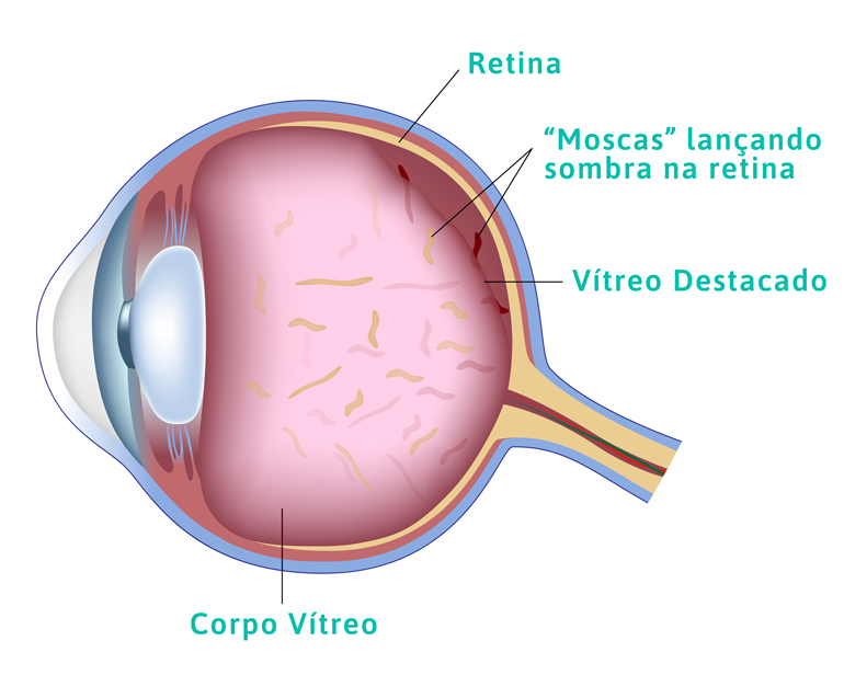 Saiba mais sobre Moscas Volantes com a Clínica Carlos Grossi Oftalmologia