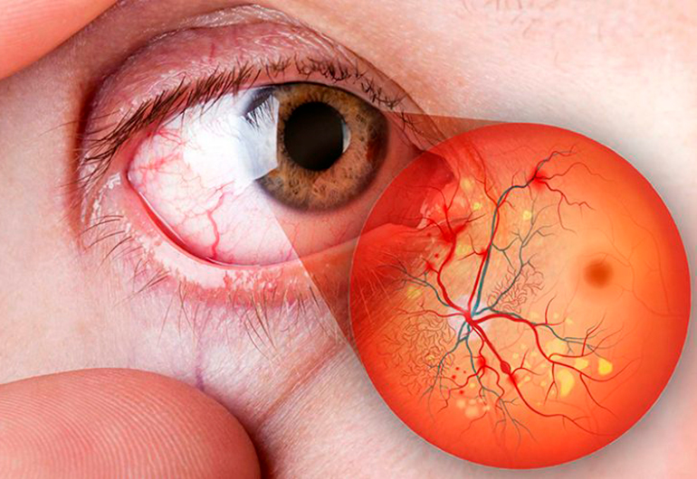 Saiba mais sobre Retinopatia diabética com a Clínica Carlos Grossi Oftalmologia